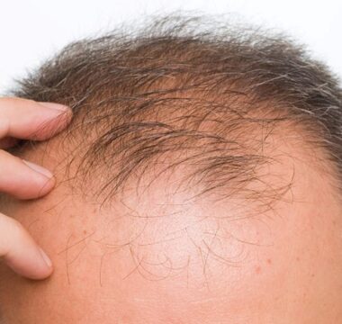 Impacts of Baldness