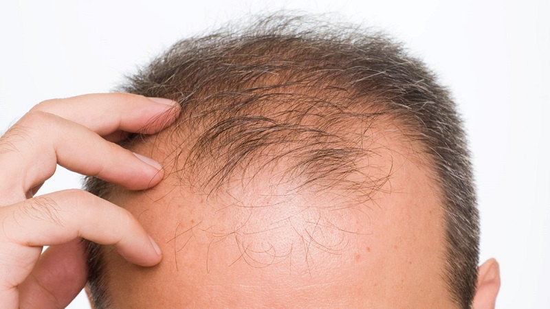 Impacts of Baldness
