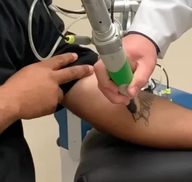 laser tattoo removal